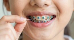 braces affect flossing routines