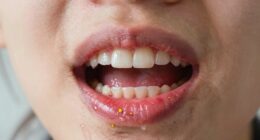 allergy related gum irritation